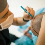 Hair Transplant Market, Size, Global Forecast 2023-2028, Industry Trends, Growth, Share, Outlook, Impact of Inflation, Opportunity Company Analysis