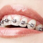 How Comfortable Are Dental Braces For Miami's Children?